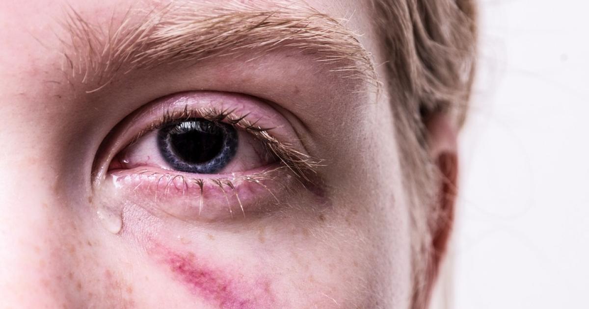 Jak se zbavit modřiny na oku?