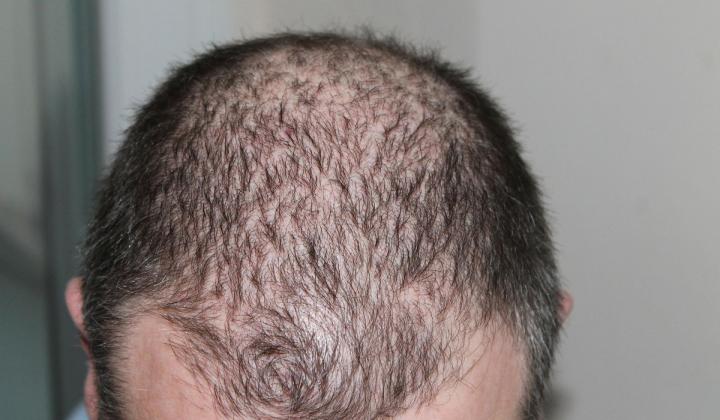 Jak léčit plešatost – 5 metod, jak se vypořádat s vypadáváním vlasů 