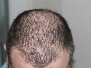Jak léčit plešatost – 5 metod, jak se vypořádat s vypadáváním vlasů 